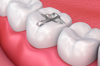Granger Dentistry | All-on-4 reg , Inlays  amp  Onlays and Snoring Appliances