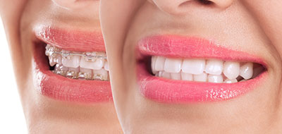 Granger Dentistry | Oral Exams, LANAP reg  and Full Mouth Reconstruction