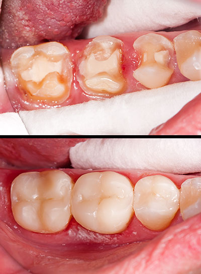 Granger Dentistry | Air Abrasion, Emergency Treatment and Crowns  amp  Caps
