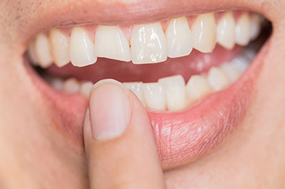 Granger Dentistry | Cosmetic Dentistry, Air Abrasion and Implant Restorations