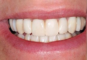 Granger Dentistry | Air Abrasion, E4D and Ceramic Crowns