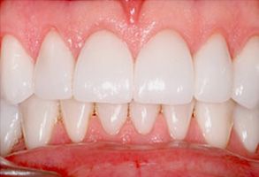 Granger Dentistry | ClearCorrect reg , E4D and Extractions